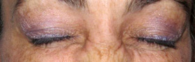 Botox Crows Feet Injections