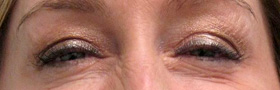 Botox Crows Feet Injections