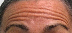 Botox Forehead Injections