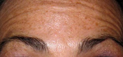 Botox Forehead Injections