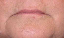 Juvederm Marionette Line Injections